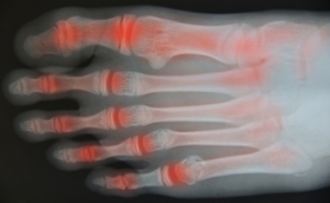 Foot Exercises for Arthritis Pain Relief