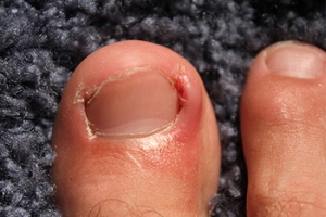Facts About Ingrown Toenails