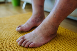 Why Diabetic Patients Experience Foot Problems
