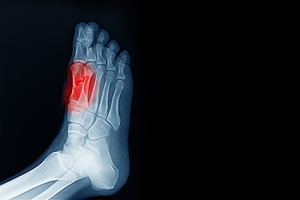 Symptoms and Risk Factors for Sesamoiditis