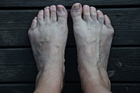 Causes and Complications of Bunionettes