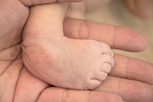 Definition and Risk Factors of Clubfoot