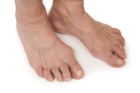 Ankle and Foot Arthropathies