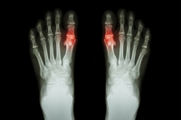 Have Painful Gout?