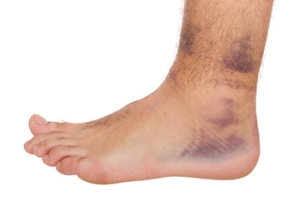 Signs of a Sprained Foot and Relief Methods